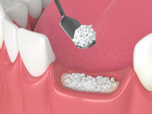 Recovering From Bone Grafting