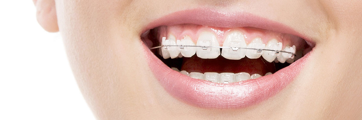 Chicago Invisible Orthodontics