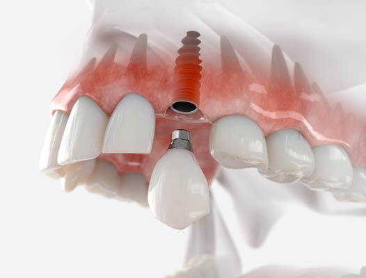 Dental Implant Chicago, IL