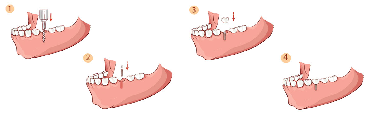 Chicago The Dental Implant Procedure