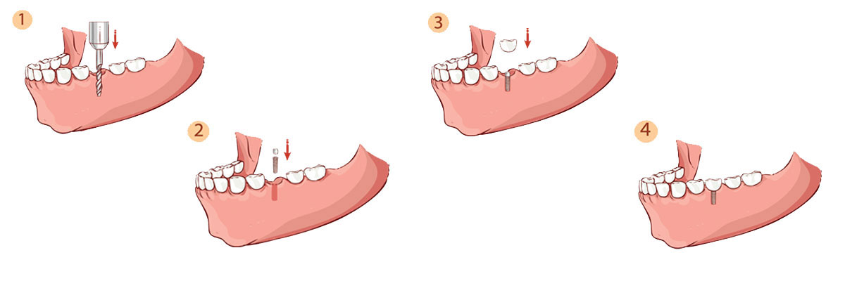 Chicago Dental Implant Restoration