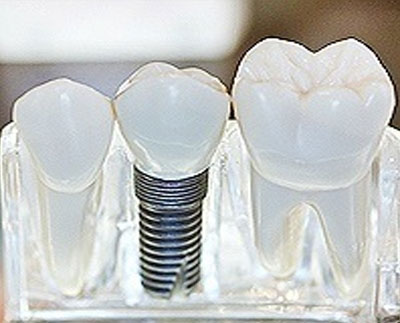 Chicago Dental Implant Restoration