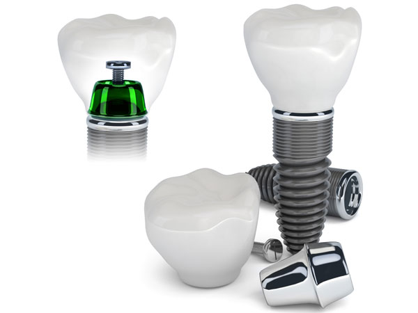 Chicago Dental Implant Surgery