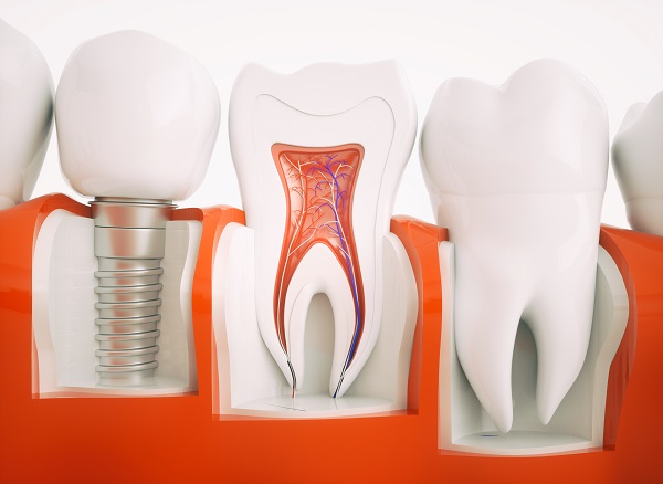 All-on-4 Dental Implants Chicago, IL