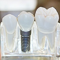 Chicago Dental Implants