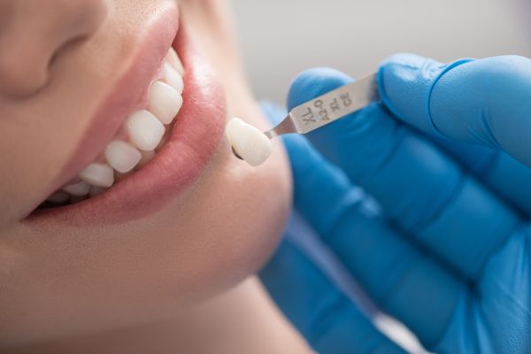 Do Veneers Protect Teeth From Cavities?