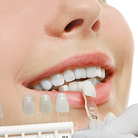 Chicago Dental Veneers and Dental Laminates
