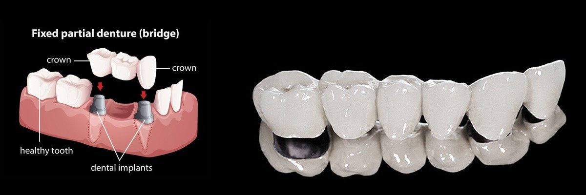 Chicago Dentures