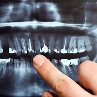 Chicago Full Mouth Reconstruction