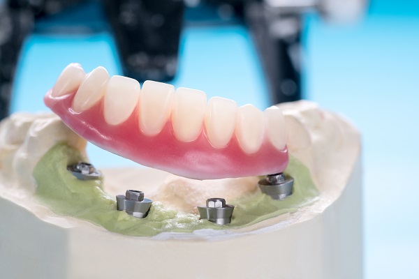 Implant Supported Dentures Procedure FAQs