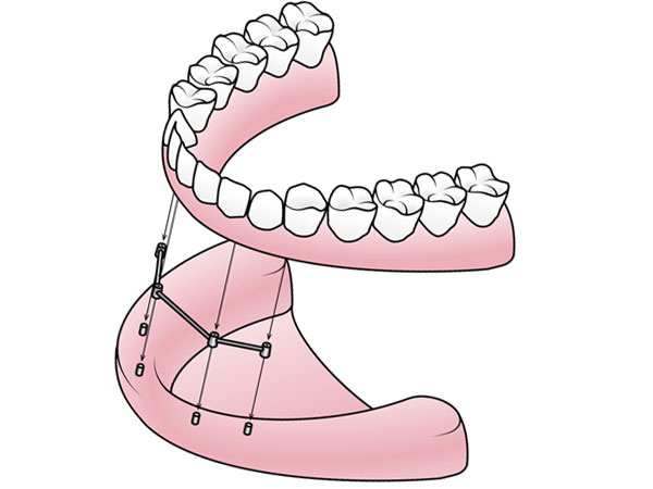 Chicago Implant Supported Dentures