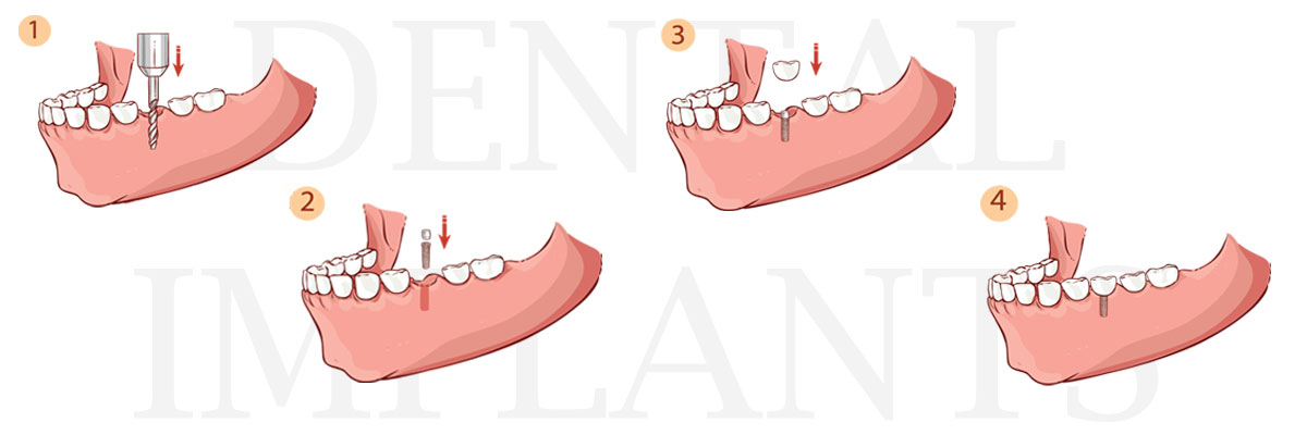 Chicago The Difference Between Dental Implants and Mini Dental Implants