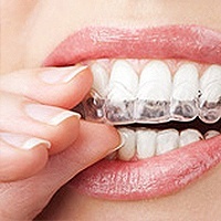 Chicago Invisalign Dentist