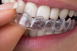 Chicago Invisalign