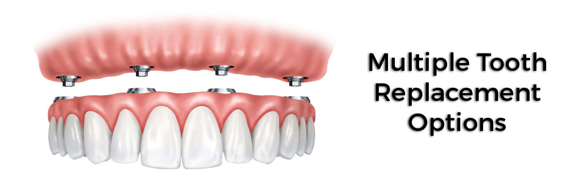 Chicago Multiple Teeth Replacement Options