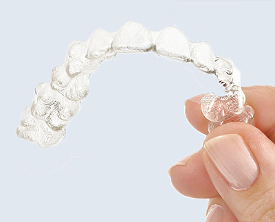 Chicago 7 Things Parents Need to Know About Invisalign Teen