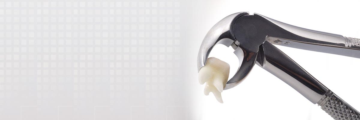 Chicago Tooth Extraction