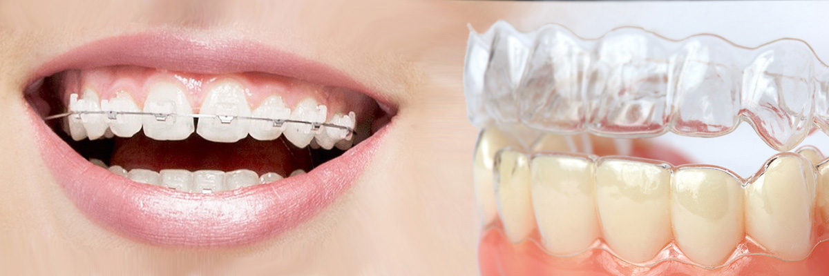 Chicago Which is Better Invisalign or Braces