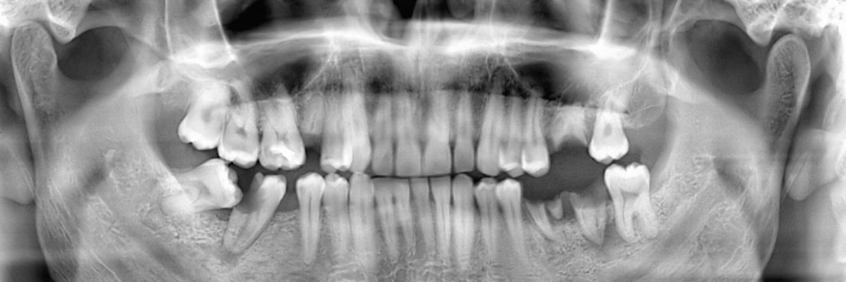 Chicago Wisdom Teeth Extraction